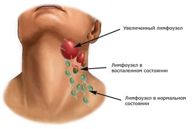 Увеличение лимфоузлов на шее