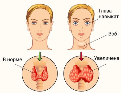 заболевание щитовидной железы