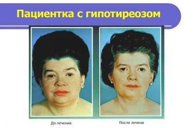 женщина с гипотиреозом