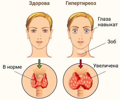 гипертиреоз