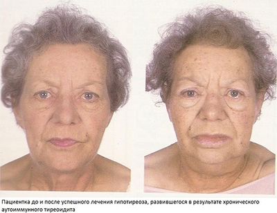 Тиреоидит пациентка до и после лечения