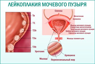 Лейкоплакия шейки мочевого пузыря