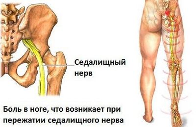 Защемление и воспаление седалищного нерва