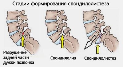 Защемление и воспаление седалищного нерва