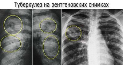 какие формы туберкулёза бывают