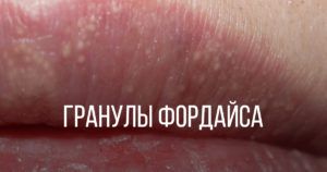 Гранулы Фордайса