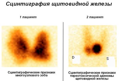 сцинтиграфия щитовидки