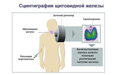 сцинтиграфия щитовидной железы