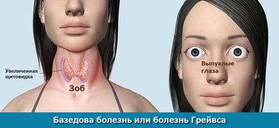 Безедова болезнь