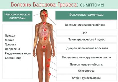 Базедова болезнь