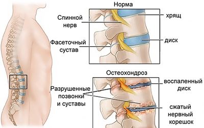 таблетки от остеохондроза