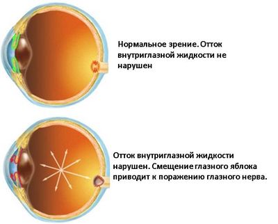 Нарушение оттока внутриглазной жидкости