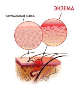 Мазь тридерм способствует устранению экземы, хронических лишаев