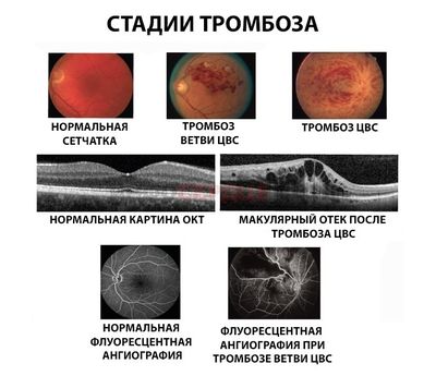 Стадии развития тромбоза