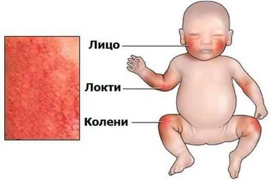 dermatit