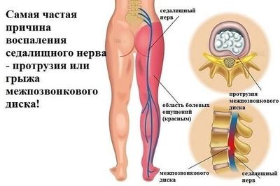 что значит воспаления седалищного нерва