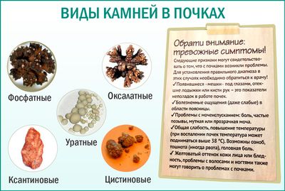 Камни в почках: какие бывают