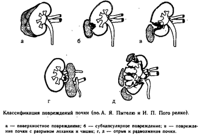 Классификация ушиба почки