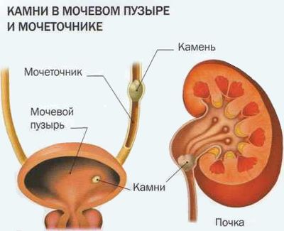 мочекаменная болезнь