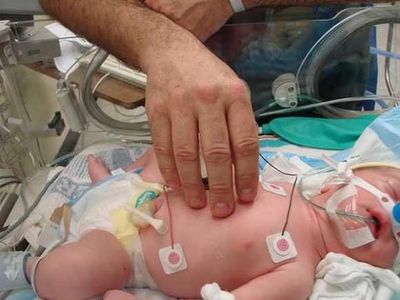 Асимметрия боковых желудочков