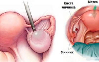 УЗИ яичников