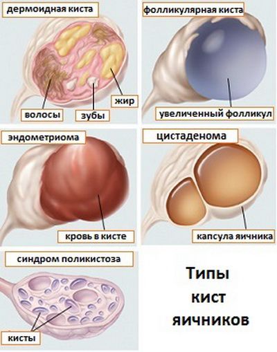 Виды кист яичника