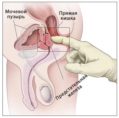 Обследование предстательной железы