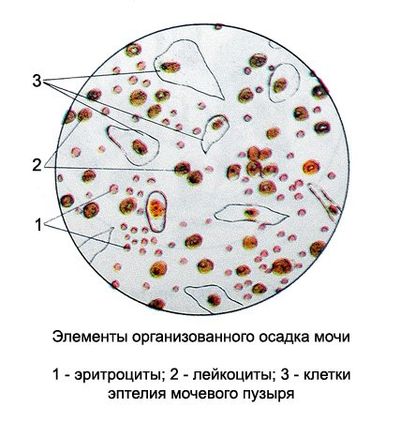 наличие эпителия и лейкоцитов в моче