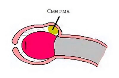 Смегма