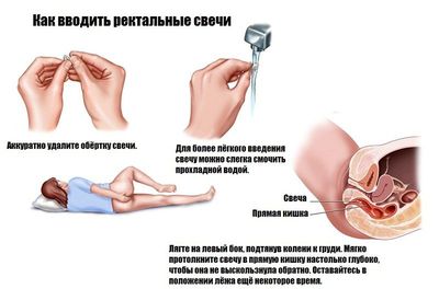 Рекомендации по введению ректальных свечей