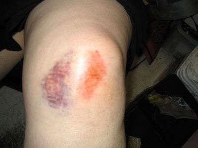 Что делать при вывихе ноги в домашних условиях?