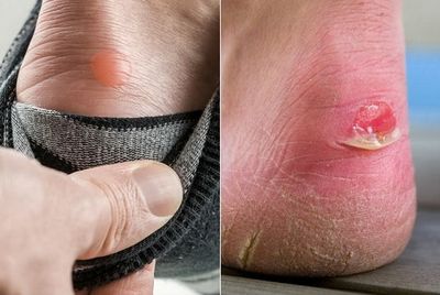 Способы лечение водяной мозоли на ноге