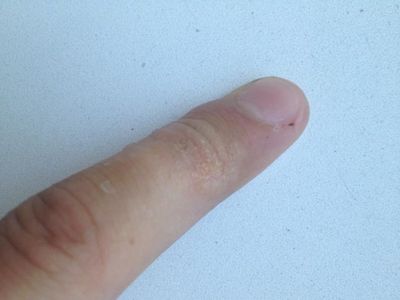 Водянистые прыщики на руках: причины появления, в чем опасность и как бороться