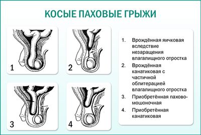 Косые паховые грыжи