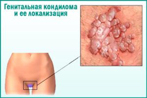 Кондиломы при беременности: причины
