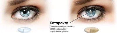 Глаз с катарактой