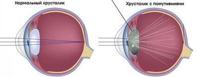 Помутнение хрусталика глаза при катаракте