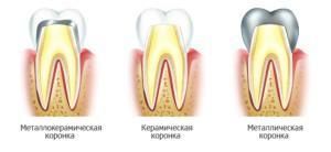 Виды коронок