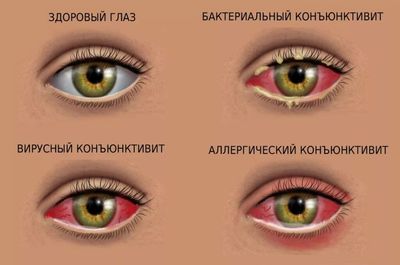 Типы конъюнктивита