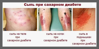 сыпь при сахарном диабете
