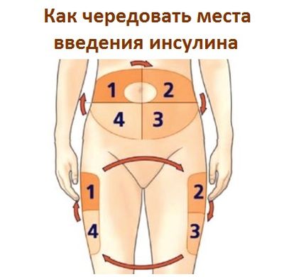 места введения инсулина