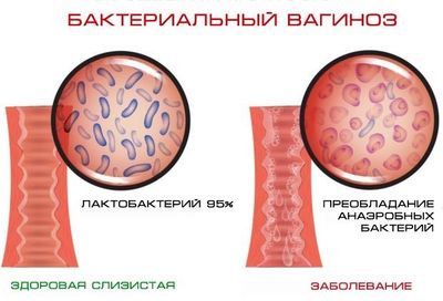 Бактериальный вагиноз