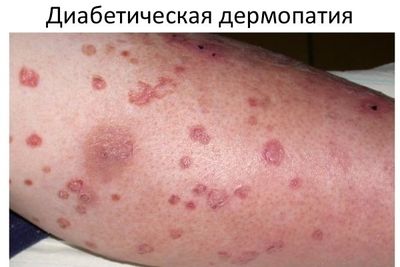 диабетическая дермопатия