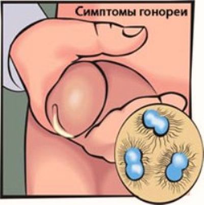 гонорея