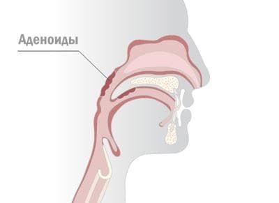vot-gde-naxodyatsya-adenoidy