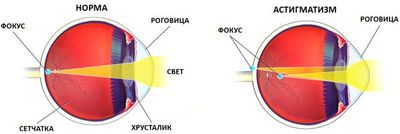 Зрение при астигматизме