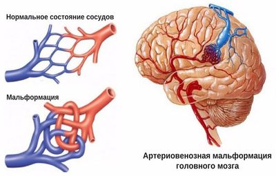 Врожденная патология строения сосудов