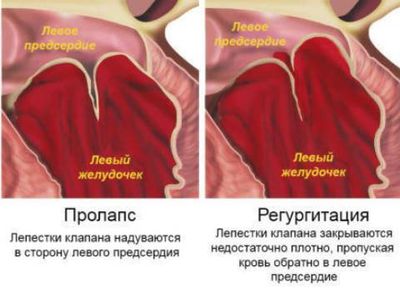 Клапанная недостаточность