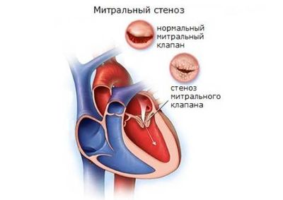 Стеноз митрального клапана