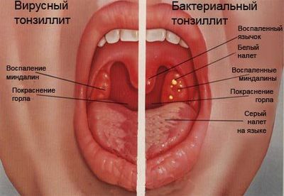 тонлиллит